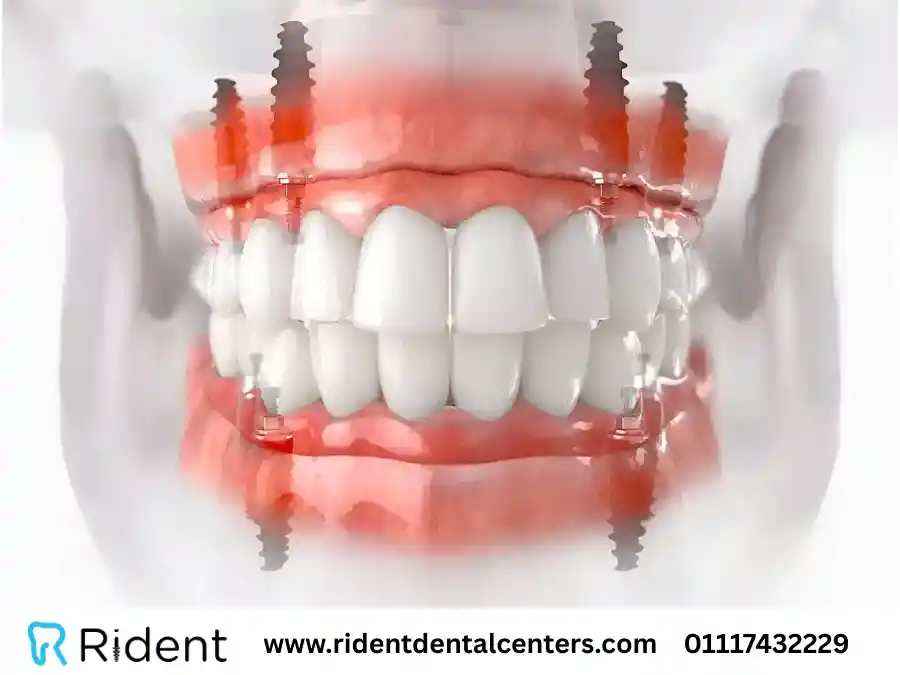 زراعة الأسنان all on 4